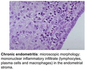 Chronic endometritis: microscopic morphology:
mononuclear inflammatory infiltrate (lymphocytes,
plasma cells and macrophages) in the endometrial
stroma.
 