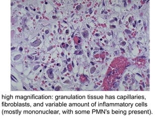 high magnification: granulation tissue has capillaries,
fibroblasts, and variable amount of inflammatory cells
(mostly mononuclear, with some PMN's being present).
 