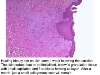 Healing biopsy site on skin seen a week following the excision,
The skin surface has re-epithelialized, below is granulation tissue
with small capillaries and fibroblasts forming collagen. After a
month, just a small collagenous scar will remain.
 