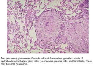 Two pulmonary granulomas. Granulomatous inflammation typically consists of
epithelioid macrophages, giant cells, lymphocytes, plasma cells, and fibroblasts. There
may be some neutrophils.
 