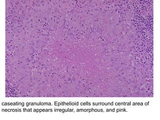 caseating granuloma. Epithelioid cells surround central area of
necrosis that appears irregular, amorphous, and pink.
 