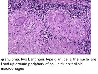 granuloma. two Langhans type giant cells. the nuclei are
lined up around periphery of cell. pink epithelioid
macrophages
 
