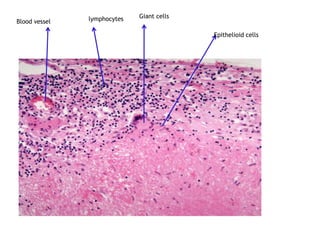 Blood vessel lymphocytes Giant cells
Epithelioid cells
 