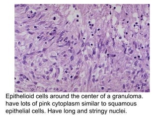 Epithelioid cells around the center of a granuloma.
have lots of pink cytoplasm similar to squamous
epithelial cells. Have long and stringy nuclei.
 