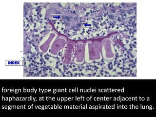 foreign body type giant cell nuclei scattered
haphazardly, at the upper left of center adjacent to a
segment of vegetable material aspirated into the lung.
 
