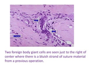 Two foreign body giant cells are seen just to the right of
center where there is a bluish strand of suture material
from a previous operation.
 