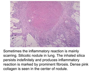 Sometimes the inflammatory reaction is mainly
scarring. Silicotic nodule in lung. The inhaled silica
persists indefinitely and produces inflammatory
reaction is marked by prominent fibrosis. Dense pink
collagen is seen in the center of nodule.
 