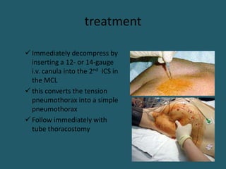 treatment
 Immediately decompress by
inserting a 12- or 14-gauge
i.v. canula into the 2nd ICS in
the MCL
 this converts the tension
pneumothorax into a simple
pneumothorax
 Follow immediately with
tube thoracostomy
 