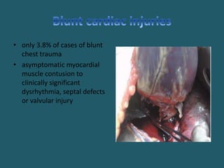 • only 3.8% of cases of blunt
chest trauma
• asymptomatic myocardial
muscle contusion to
clinically significant
dysrhythmia, septal defects
or valvular injury
 