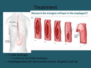 Treatment
• Injuries identified within 24hrs
– Debridement and Primary repair + mediastinal drainage
• More than 24hrs
– Primary repair buttressed with vascularized autologous
tissue(parietal pleura & intercostal muscle)
– cervical esophagostomy , distal part stapled, gastrostomy and
feeding jejunostomy , mediastinal drainage for
• Critical pts and advanced mediastinitis or
• severe associated injuries
– T-tube drainage
• in critical pt and friable esophagus
– Esophagectomy for destructive injuries & gastric pull-up
 