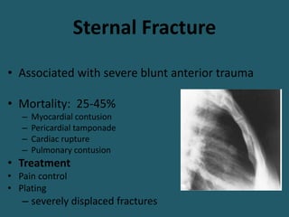 Sternal Fracture
• Associated with severe blunt anterior trauma
• Mortality: 25-45%
– Myocardial contusion
– Pericardial tamponade
– Cardiac rupture
– Pulmonary contusion
• Treatment
• Pain control
• Plating
– severely displaced fractures
 