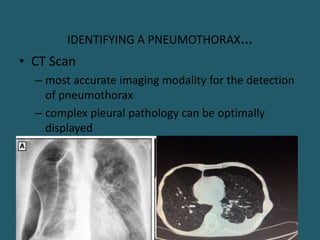 IDENTIFYING A PNEUMOTHORAX…
• CT Scan
– most accurate imaging modality for the detection
of pneumothorax
– complex pleural pathology can be optimally
displayed
 