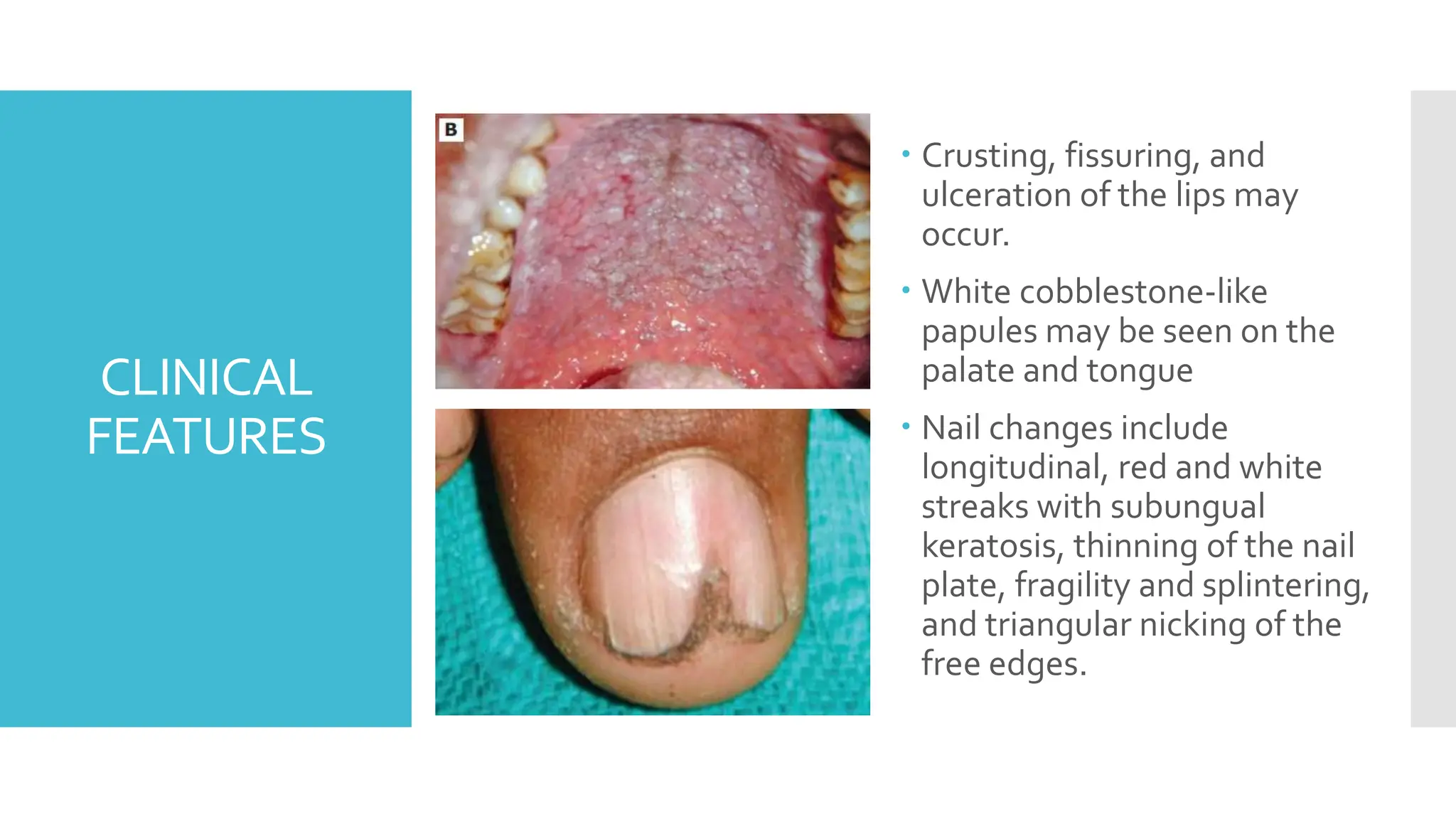 Darier s Disease PPTX Darier s Disease PPTX