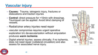 Finger Devascularization 4. Hand Injury Management 2gggggg021.pptx