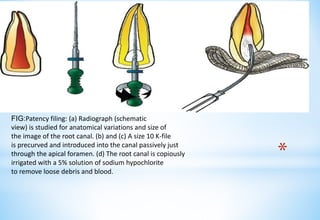 *
FIG:Patency filing: (a) Radiograph (schematic
view) is studied for anatomical variations and size of
the image of the root canal. (b) and (c) A size 10 K-file
is precurved and introduced into the canal passively just
through the apical foramen. (d) The root canal is copiously
irrigated with a 5% solution of sodium hypochlorite
to remove loose debris and blood.
 