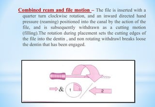 Combined ream and file motion – The file is inserted with a
quarter turn clockwise rotation, and an inward directed hand
pressure (reaming) positioned into the canal by the action of the
file, and is subsequently withdrawn as a cutting motion
(filling).The rotation during placement sets the cutting edges of
the file into the dentin , and non rotating withdrawl breaks loose
the dentin that has been engaged.
 