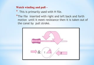 Watch winding and pull –
*. This is primarily used with H file.
*The file inserted with right and left back and forth
motion until it meet resistance then it is taken out of
the canal by pull stroke.
 