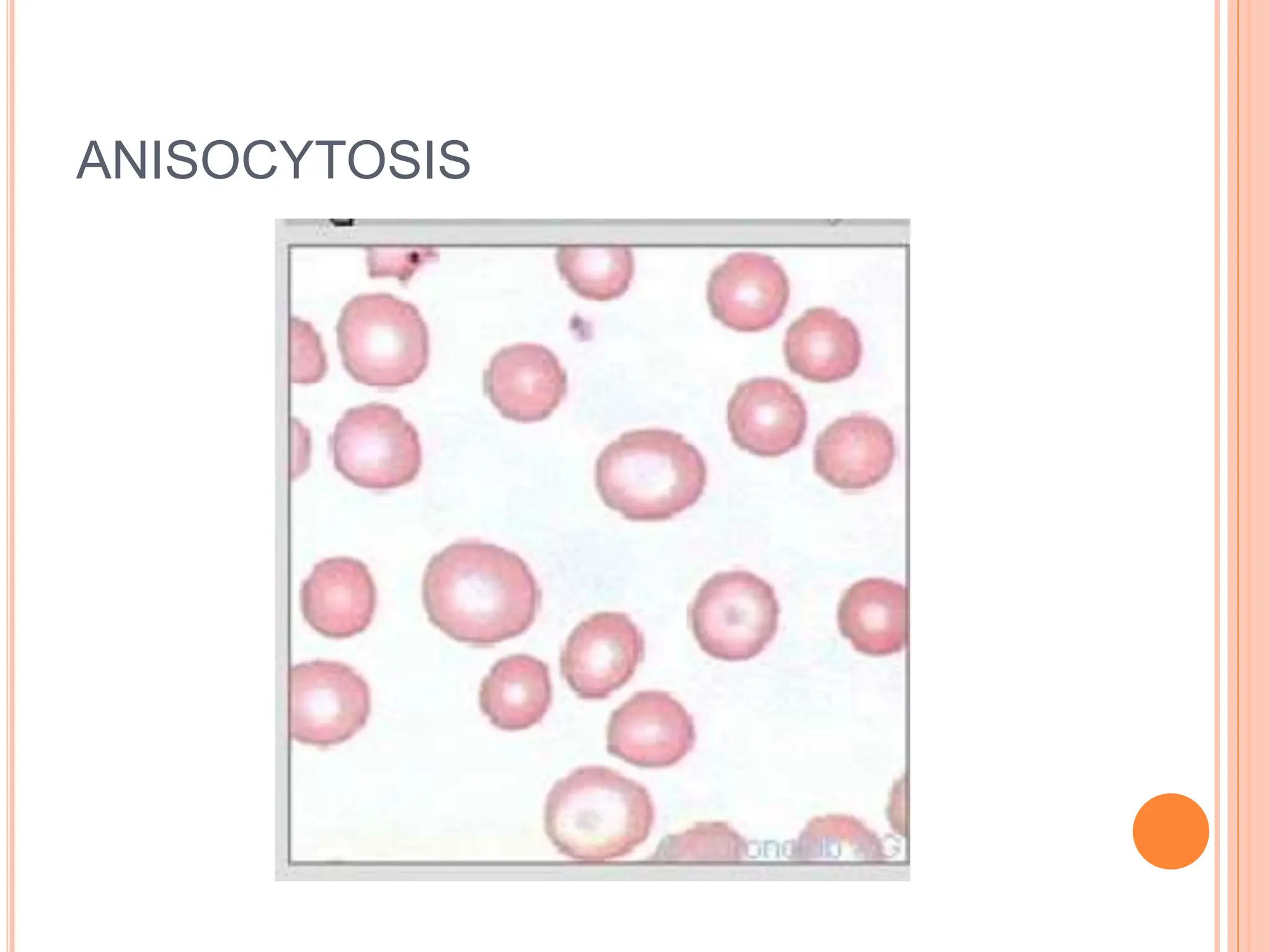 ANISOCYTOSIS
 