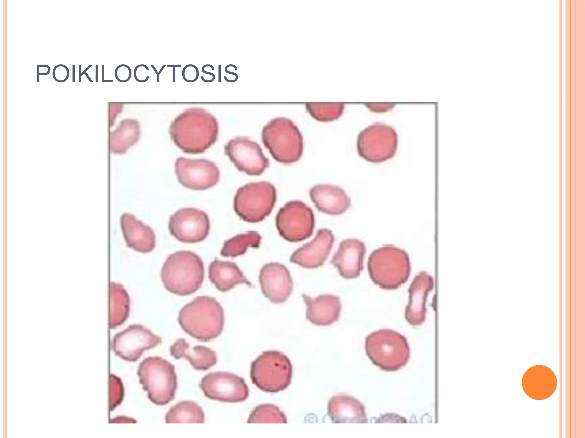 POIKILOCYTOSIS
 