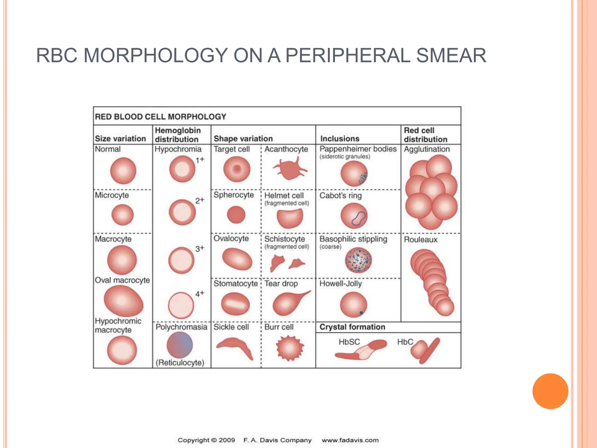 RBC MORPHOLOGY ON A PERIPHERAL SMEAR
 
