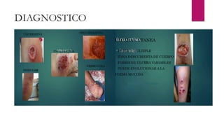 ULCERATIVA
NODULAR
INFILTRATIVA
PROLIFERATIVA
VERRUCOSA
ULCERA CUTANEA
. UNICA O MULTIPLE
. ZONA DESCUBIERTA DE CUERPO
. FORMA DE ULCERA VARIABLES
. PUEDE EVOLUCIONAR A LA
FORMA MUCOSA
 