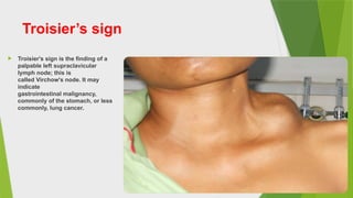 Toisier Sign 4. Gastric Cancer.pptx666666666666666666666666666 | PPTX