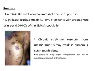 Uremic Rashes 4. Skin manifestations of the systemic diseases in processes and ...