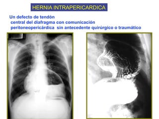 4.Hernia diafragmática y diverticulos del esófago.pptx