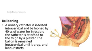 4.23_Induction of labor_PPT .pptx