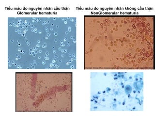 Tiểu máu do nguyên nhân cầu thận
Glomerular hematuria
Tiểu máu do nguyên nhân không cầu thận
NonGlomerular hematuria
 