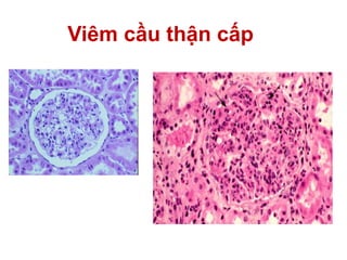 Viêm cầu thận cấp
Cầu thận bình thường
 