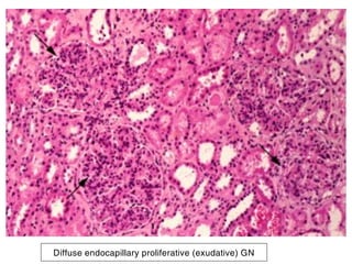 Diffuse endocapillary proliferative (exudative) GN
 