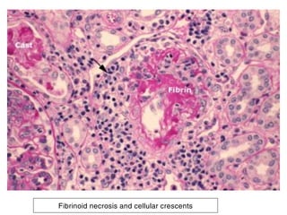 Fibrinoid necrosis and cellular crescents
 