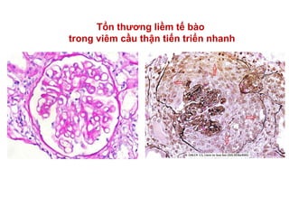 Tổn thương liềm tế bào
trong viêm cầu thận tiến triển nhanh
 