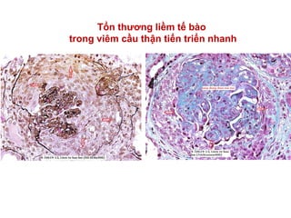 Tổn thương liềm tế bào
trong viêm cầu thận tiến triển nhanh
 