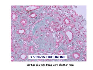 Xơ hóa cầu thận trong viêm cầu thận mạn
 