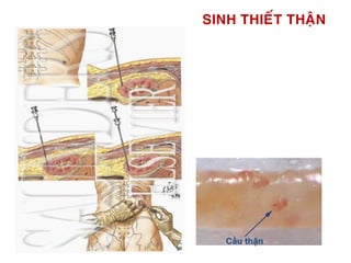 SINH THIEÁT THAÄN
Cầu thận
Khaûo saùt
-Kính hieån vi quang hoïc
-Mieãn dòch huyønh quang
- Kính hieån vi ñieän töû
 