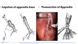APPENDECTOMY - General Surgery Medicine Course | PDF