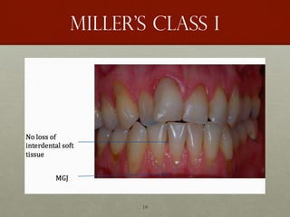 19
Miller’s class I
 