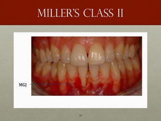 20
Miller’s class II
 