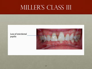 22
Miller’s class III
 