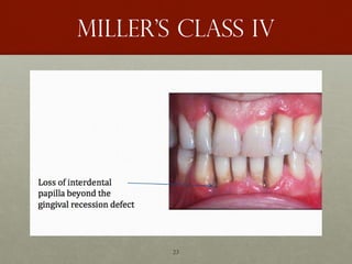 23
Miller’s class IV
 