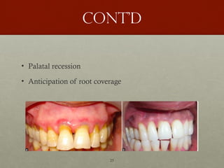 25
Cont’d
• Palatal recession
• Anticipation of root coverage
 