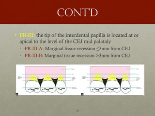 37
Cont’d
• PR-III: the tip of the interdental papilla is located at or
apical to the level of the CEJ mid palataly
• PR-III-A: Marginal tissue recession ≤3mm from CEJ
• PR-III-B: Marginal tissue recession >3mm from CEJ
 
