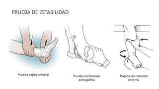 PRUEBA DE ESTABILIDAD
Prueba cajón anterior Prueba inclinación
astragalina
Prueba de rotación
externa
 