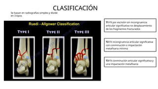 CLASIFICACIÓN
Se basan en radiografías simples y divide
en 3 tipos
T1 FX por escisión sin incongruencia
articular significativa no desplazamiento
de los fragmentos fracturados
T2 FX incongruencia articular significativa
con conminución o impactación
metafisaria mínima
T3 FX conminución articular significativa y
una impactación metafisaria
 
