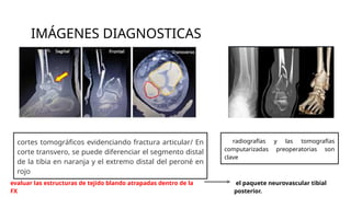 IMÁGENES DIAGNOSTICAS
cortes tomográficos evidenciando fractura articular/ En
corte transvero, se puede diferenciar el segmento distal
de la tibia en naranja y el extremo distal del peroné en
rojo
radiografías y las tomografías
computarizadas preoperatorias son
clave
evaluar las estructuras de tejido blando atrapadas dentro de la
FX
el paquete neurovascular tibial
posterior.
 
