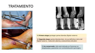TRATAMIENTO
1. Primera etapa (proteger partes blandas )fijador externo
2. Segunda etapa: partes blandas bien, tto qx definitivo retiro del
fijador externo , reducción abierta y osteosíntesis del pilon
El tto conservador sólo está indicado en fracturas no
desplazadas y pacientes con contraindicación quirúrgica.
 