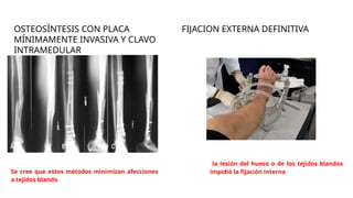 OSTEOSÍNTESIS CON PLACA
MÍNIMAMENTE INVASIVA Y CLAVO
INTRAMEDULAR
Se cree que estos métodos minimizan afecciones
a tejidos blando
FIJACION EXTERNA DEFINITIVA
la lesión del hueso o de los tejidos blandos
impidió la fijación interna
 