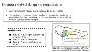 Fractura proximal del quinto metatarsiano
➔ Suelen presentarse tras una inversión aguda del pie o del tobillo.
➔ Los pacientes presentan dolor localizado, equimosis, hinchazón e
incapacidad para soportar peso en la cara lateral del pie, y a veces sólo se
ambulan por la cara medial del pie.
Clasificación
● Zona 1 : Fractura por avulsión de
la tuberosidad
● Zona 2 : Fractura de Jones
● Zona 3 : Fractura diafisaria por
estrés
 